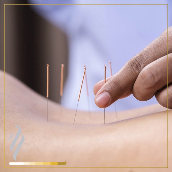 Acupuntura