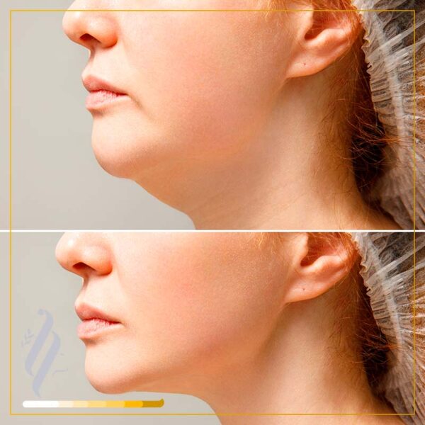 Embrace RF (Facetite-Accutite)